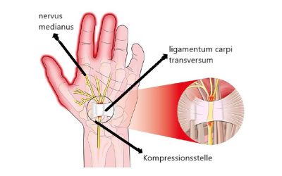 Plagt Sie Kribbeln und Ungeschick der Finger?